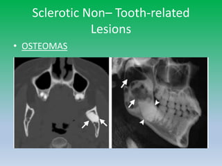 Sclerotic Non– Tooth-related
Lesions
• OSTEOMAS
 