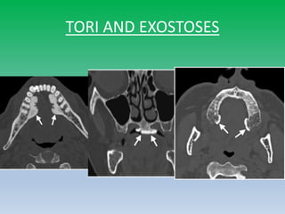 TORI AND EXOSTOSES
 