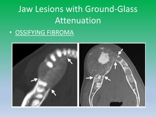 Jaw Lesions with Ground-Glass
Attenuation
• OSSIFYING FIBROMA
 