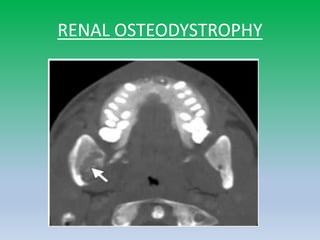 RENAL OSTEODYSTROPHY
 