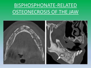 BISPHOSPHONATE-RELATED
OSTEONECROSIS OF THE JAW
 