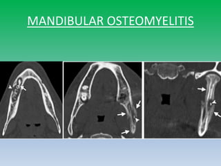 MANDIBULAR OSTEOMYELITIS
 