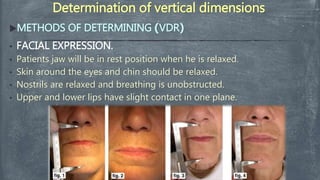 Determination of vertical dimensions
METHODS OF DETERMINING )VDR(
• FACIAL EXPRESSION.
• Patients jaw will be in rest position when he is relaxed.
• Skin around the eyes and chin should be relaxed.
• Nostrils are relaxed and breathing is unobstructed.
• Upper and lower lips have slight contact in one plane.
 