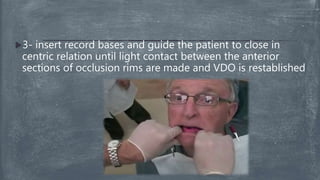 3- insert record bases and guide the patient to close in
centric relation until light contact between the anterior
sections of occlusion rims are made and VDO is restablished
 