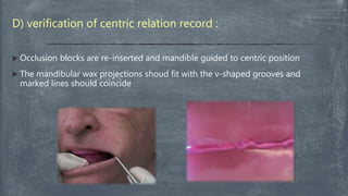 D) verification of centric relation record :
 Occlusion blocks are re-inserted and mandible guided to centric position
 The mandibular wax projections shoud fit with the v-shaped grooves and
marked lines should coincide
 
