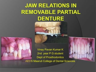 Vinay Pavan Kumar K
2nd year P G student
Dept of Prosthodontics
AECS Maaruti College of Dental Sciences
 