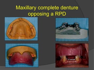 Jaw relation in rpd | PPTX
