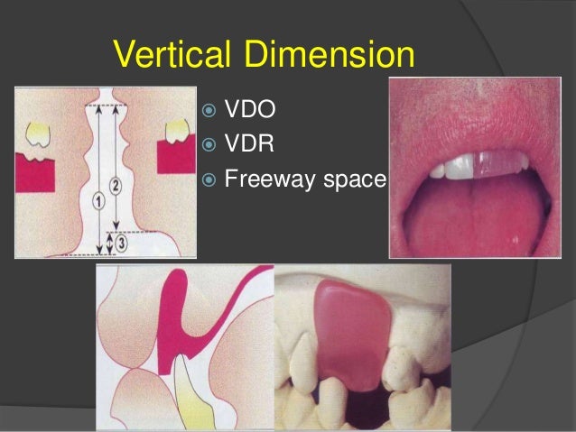 jaw rpd occlusion vdo freeway vdr