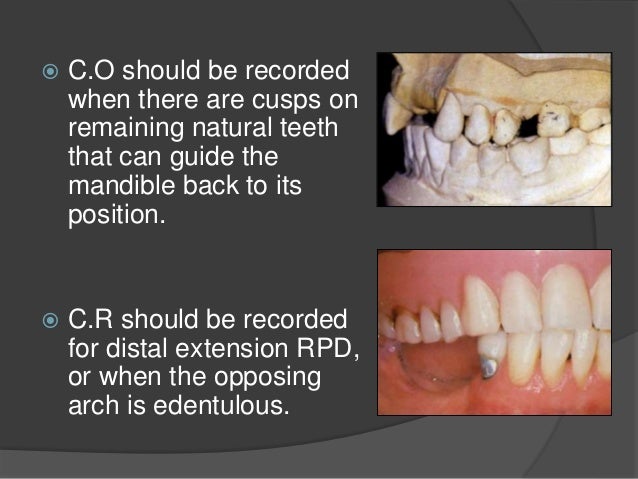 rpd dentures occlusal bilateral