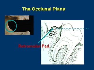 The Occlusal Plane

Retromolar Pad

 