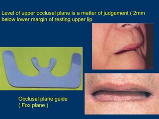 Level of upper occlusal plane is a matter of judgement ( 2mm
below lower margin of resting upper lip

Occlusal plane guide...