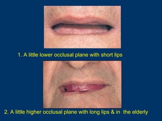1. A little lower occlusal plane with short lips

2. A little higher occlusal plane with long lips & in the elderly

 