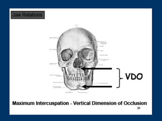 OVD is too great , face looks
distorted & lips are incompetent

OVD is too small , vermilion
border appears thin & wrinkle...