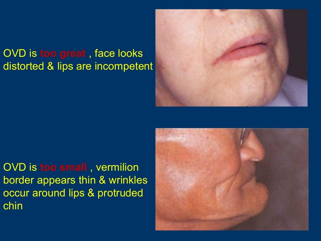 Jaw relation