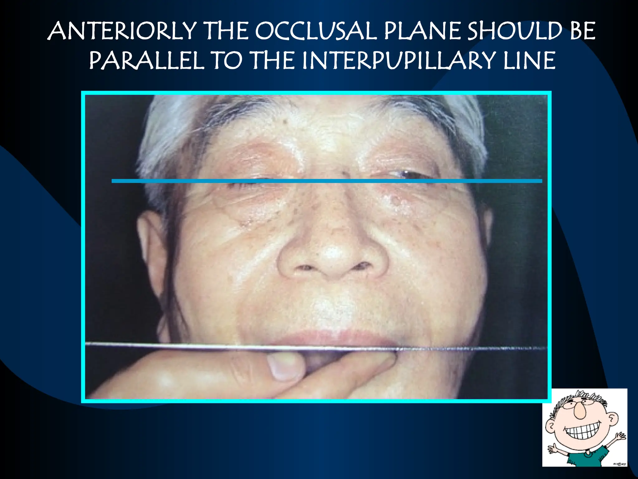 ANTERIORLY THE OCCLUSAL PLANE SHOULD BE
PARALLEL TO THE INTERPUPILLARY LINE
 