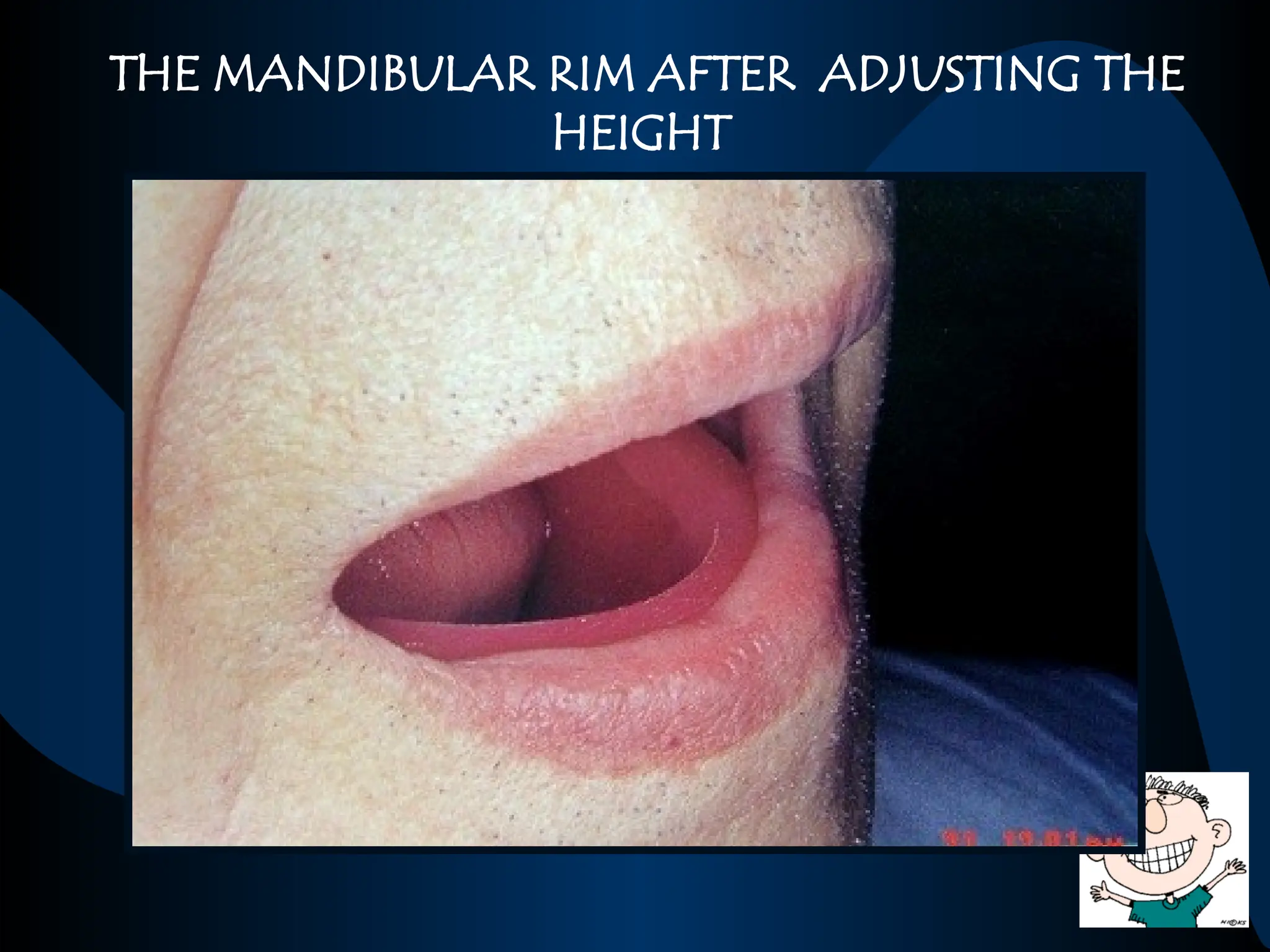 THE MANDIBULAR RIM AFTER ADJUSTING THE
HEIGHT
 