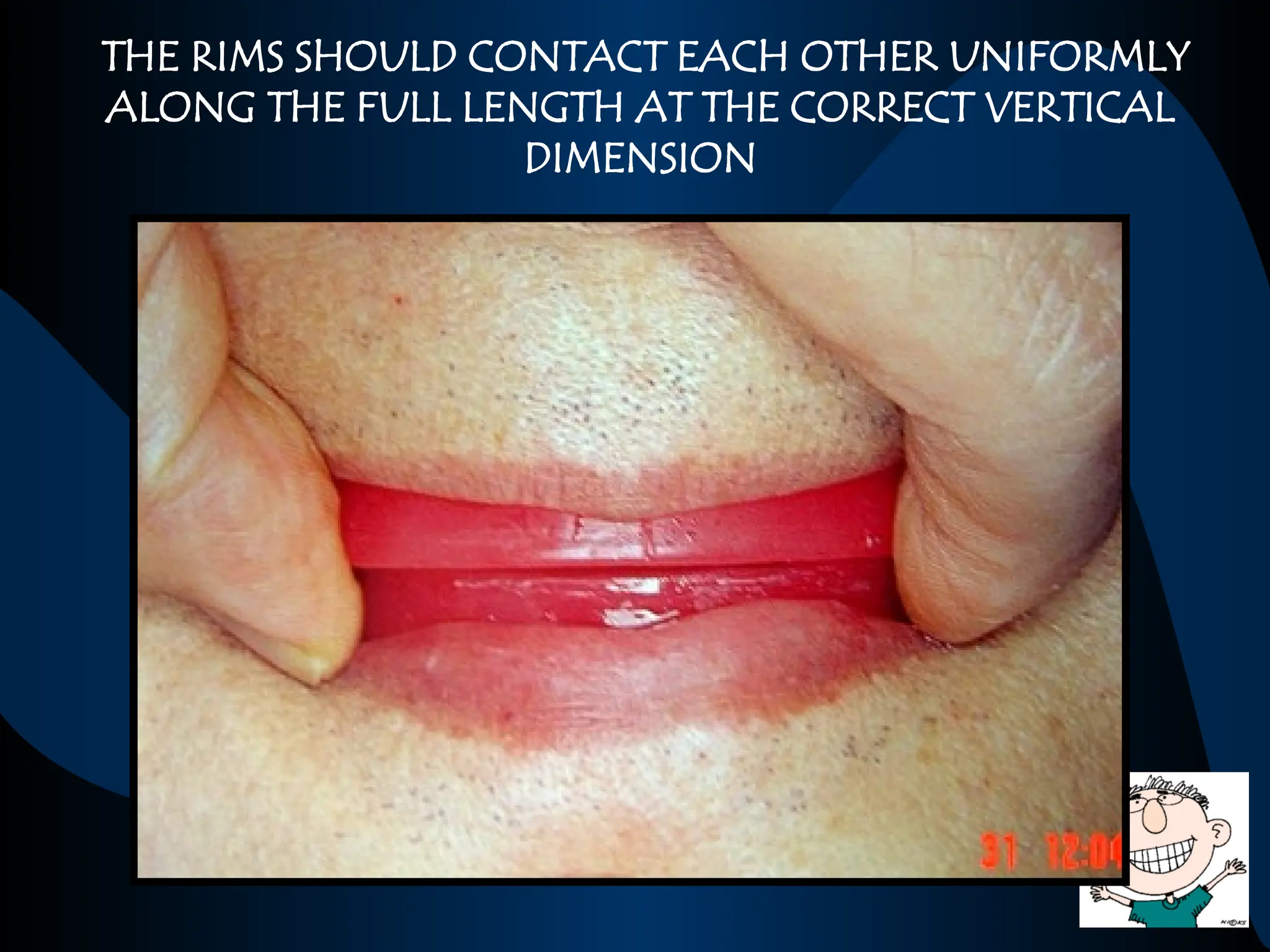 THE RIMS SHOULD CONTACT EACH OTHER UNIFORMLY
ALONG THE FULL LENGTH AT THE CORRECT VERTICAL
DIMENSION
 