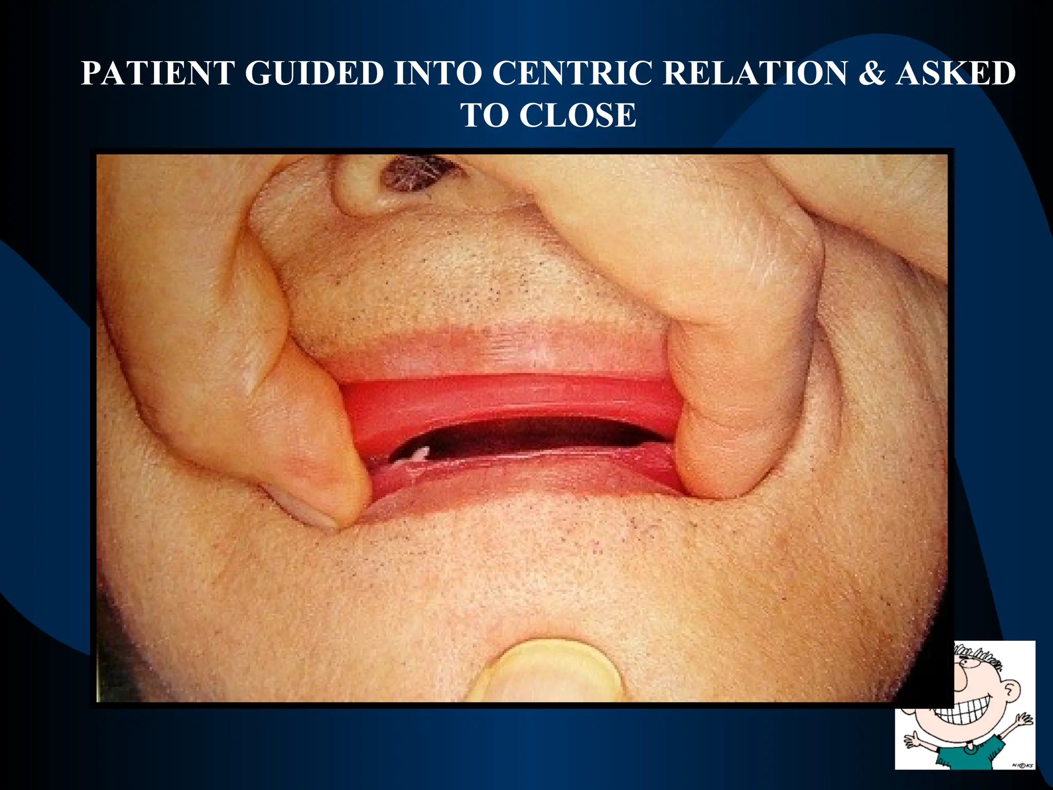 PATIENT GUIDED INTO CENTRIC RELATION & ASKED
TO CLOSE
 