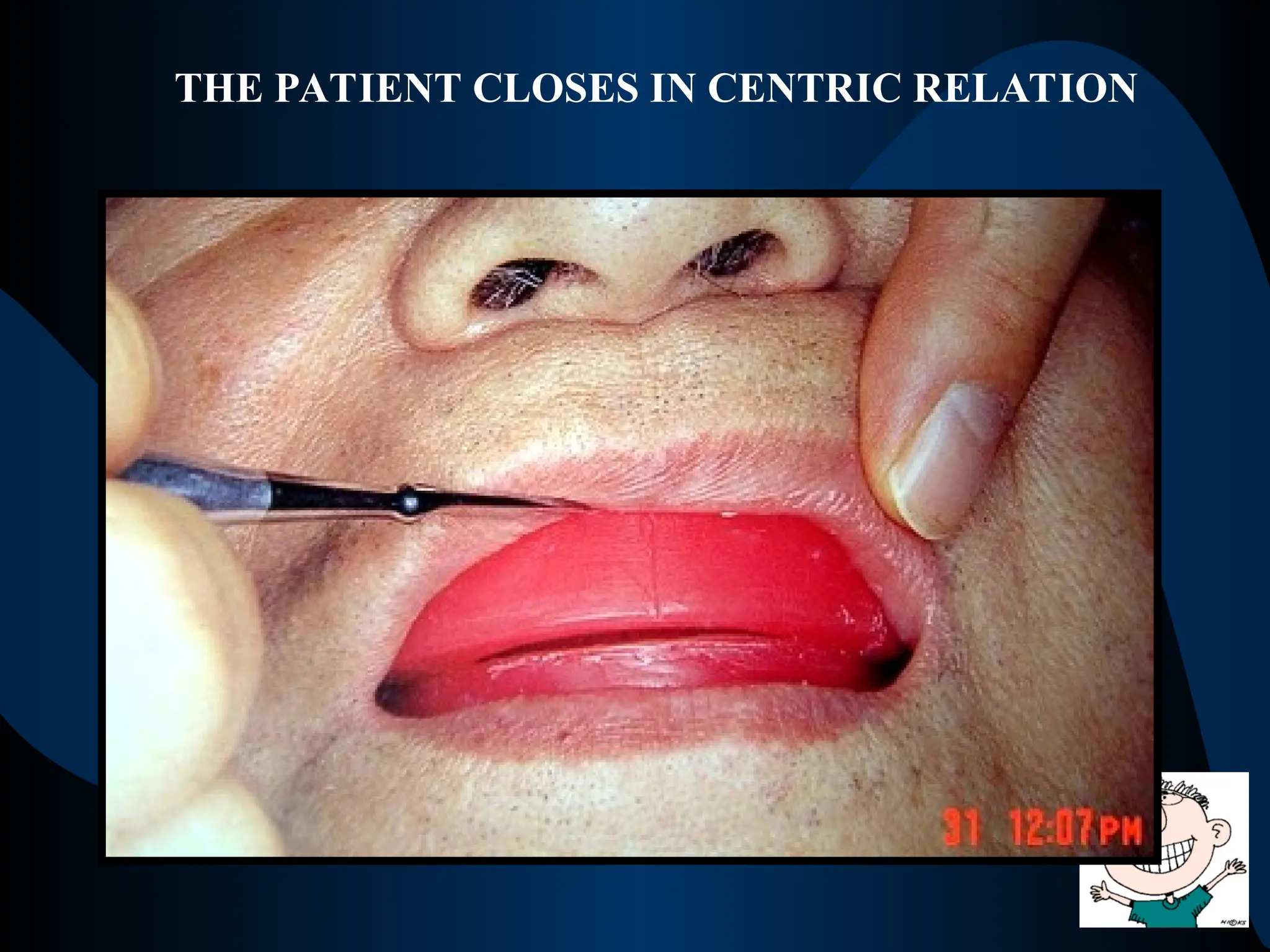 THE PATIENT CLOSES IN CENTRIC RELATION
 