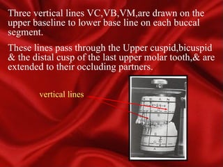Jaw relationship records for orthognathic surgery .ppt