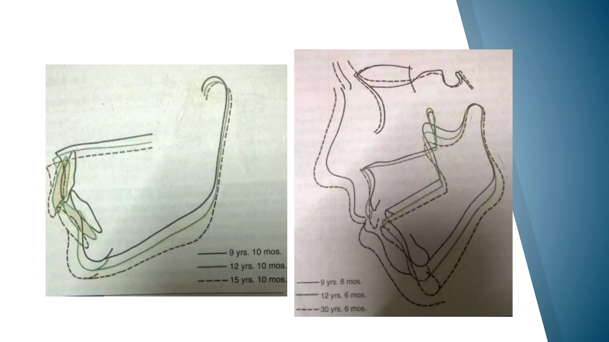 Jaw rotation(ortho) | PPTX