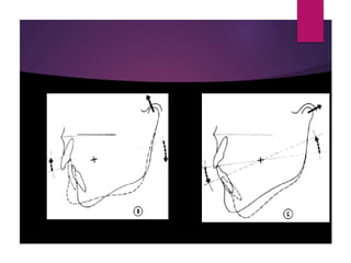 Jaw rotations