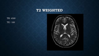 T2 WEIGHTED
TR: 4500
TE : 100
 