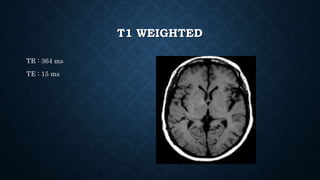 T1 WEIGHTED
TR : 364 ms
TE : 15 ms
 