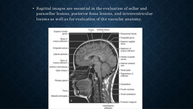 MRI Brain