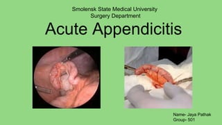 Acute Appendicitis
Smolensk State Medical University
Surgery Department
Name- Jaya Pathak
Group- 501
 