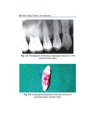 Jaypee mini atlas series periodontics | PDF