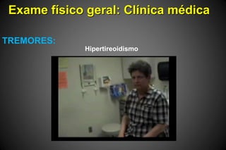 Exame físico geral: Clínica médica
TREMORES:
Hipertireoidismo
 