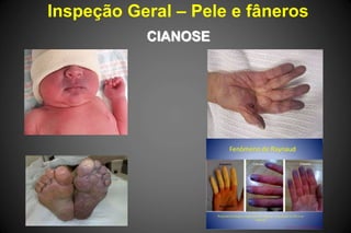 Inspeção Geral – Pele e fâneros
CIANOSE
 