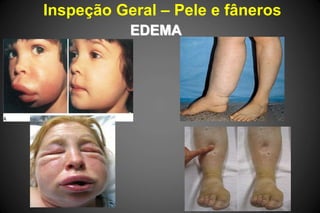 Inspeção Geral – Pele e fâneros
EDEMA
 