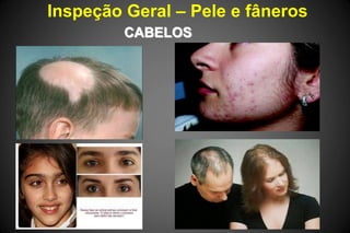 Inspeção Geral – Pele e fâneros
CABELOS
 