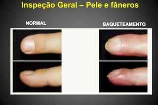 Inspeção Geral – Pele e fâneros
NORMAL BAQUETEAMENTO
 
