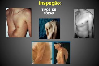 Inspeção:
TIPOS DE
TÓRAX
 
