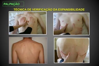 TÉCNICA DE VERIFICAÇÃO DA EXPANSIBILIDADE
PALPAÇÃO
 