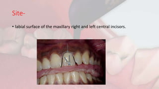Site-
• labial surface of the maxillary right and left central incisors.
 