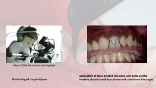 Positioning of the participant.
Application of black braided silk along with gutta percha
markers placed at mid-buccal area and transitional line angle.
Nikon D-300S, 60 mm lens and ring flash
 