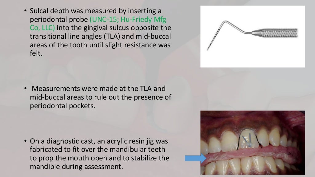 gingival retraction methods