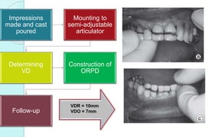 Impressions
made and cast
poured
Mounting to
semi-adjustable
articulator
Determining
VD
Construction of
ORPD
Follow-up
VDR = 10mm
VDO = 7mm
 
