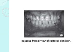 Intraoral frontal view of restored dentition.
 
