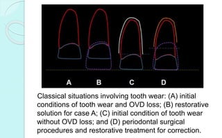 Classical situations involving tooth wear: (A) initial
conditions of tooth wear and OVD loss; (B) restorative
solution for case A; (C) initial condition of tooth wear
without OVD loss; and (D) periodontal surgical
procedures and restorative treatment for correction.
 