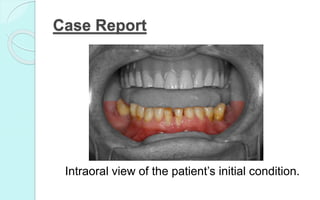 Case Report
Intraoral view of the patient’s initial condition.
 