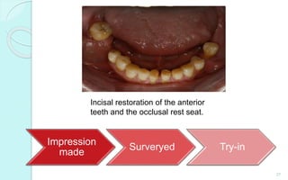 Impression
made
Surveryed Try-in
27
Incisal restoration of the anterior
teeth and the occlusal rest seat.
 