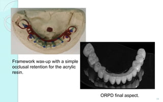 28
Framework wax-up with a simple
occlusal retention for the acrylic
resin.
ORPD final aspect.
 