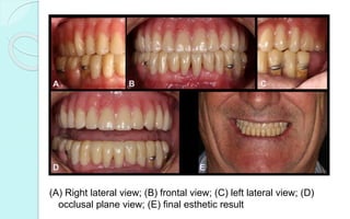 (A) Right lateral view; (B) frontal view; (C) left lateral view; (D)
occlusal plane view; (E) final esthetic result
 