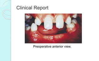 Clinical Report
Preoperative anterior view.
 