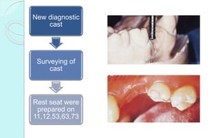 New diagnostic
cast
Surveying of
cast
Rest seat were
prepared on
11,12,53,63,73
 